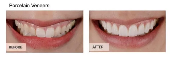 Porcelain veneers smile transformation