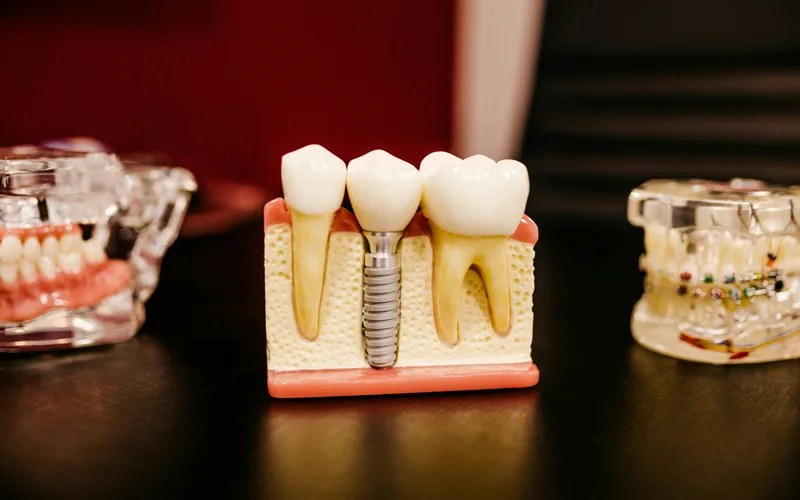 Dental crown displayed on a tooth model showing full-coverage restoration