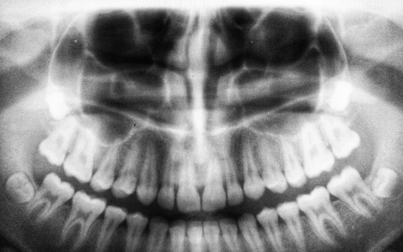 Dental X-ray showing a titanium implant post integrated with the jawbone