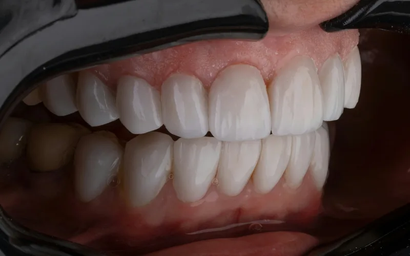 Ultra-thin porcelain veneer shell held up to show its translucent quality
