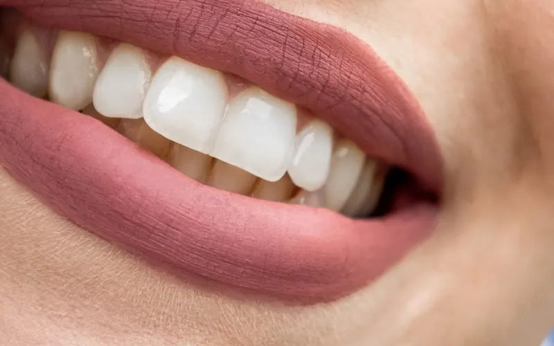Dental consultation reviewing 2026 teeth whitening pricing at HB Dentist in Huntington Beach