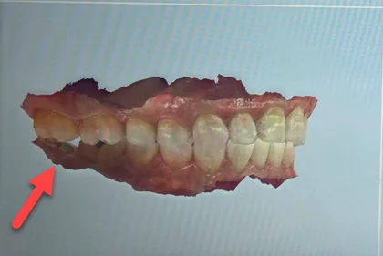 Side view of the patient's lower teeth before treatment, with an arrow identifying the short back tooth