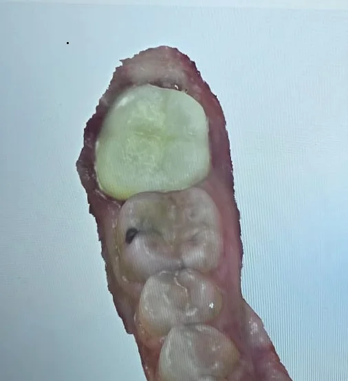 Top-down digital scan of the completed crown seated in the lower arch