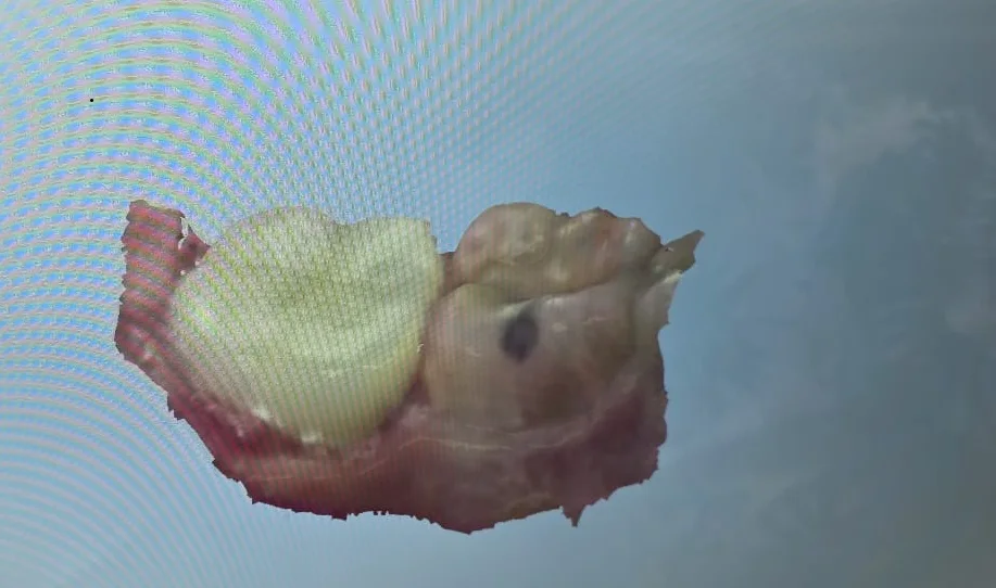Digital scan showing a completed crown on a lower back tooth