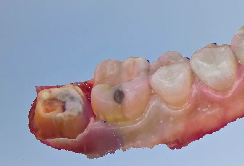 Close digital scan of the back tooth after additional tooth structure was exposed