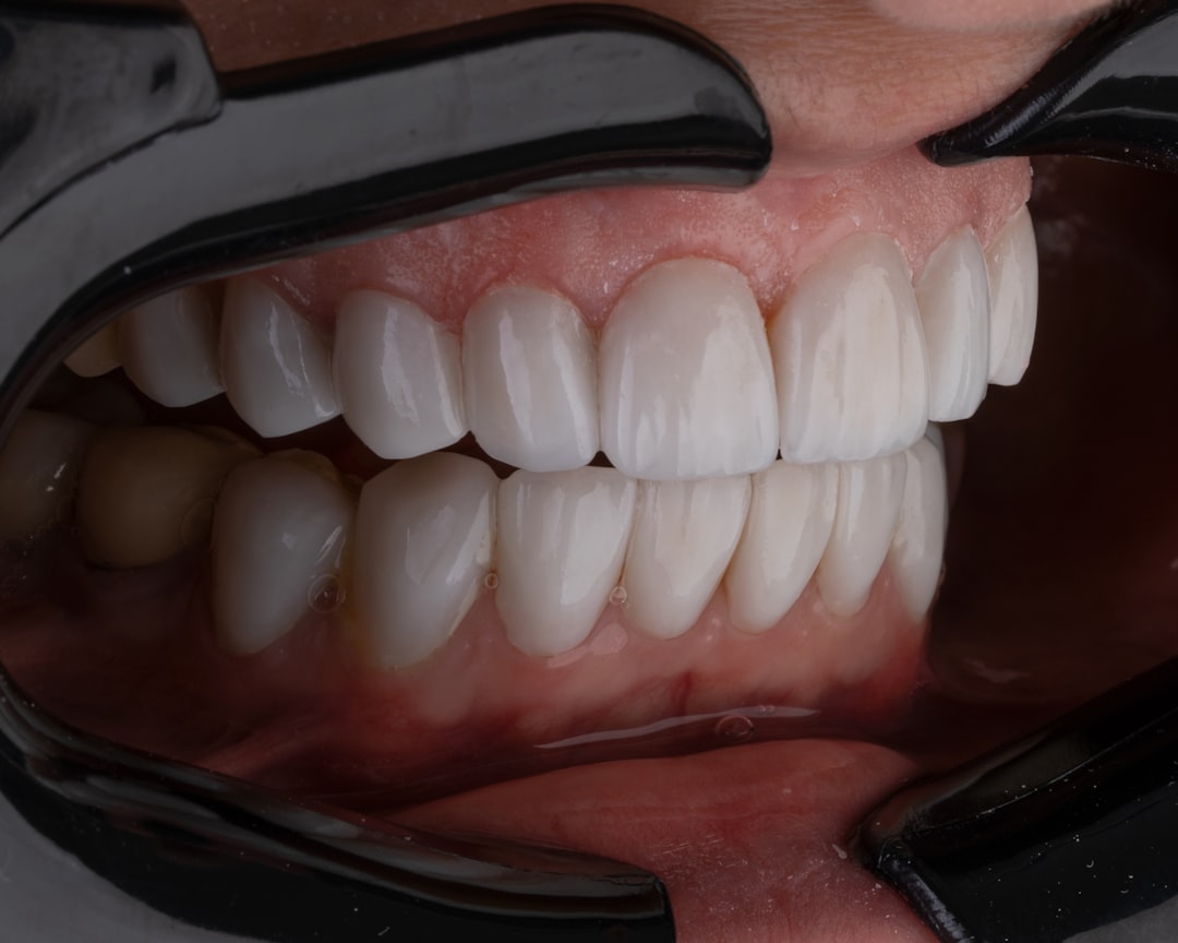 How Much Are Veneers Per Tooth? Real Huntington Beach Pricing Tiers