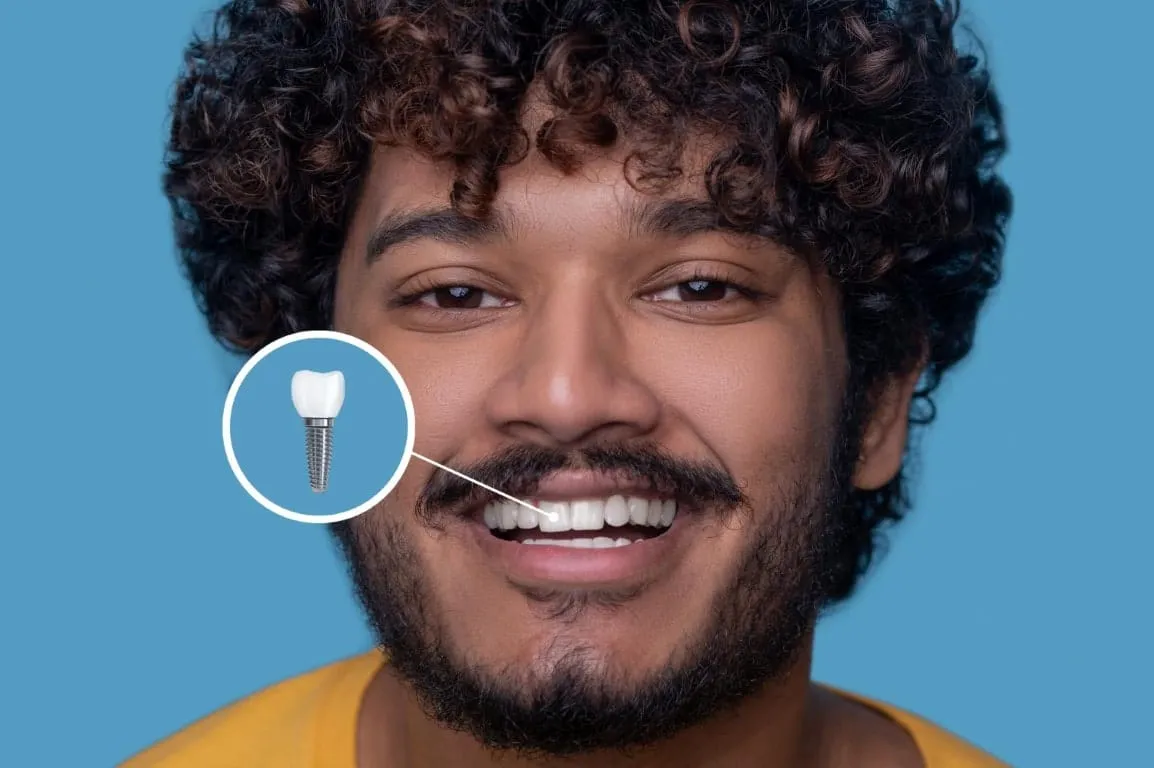 Full Mouth Dental Implants: All-on-4 Guide for Huntington Beach Patients