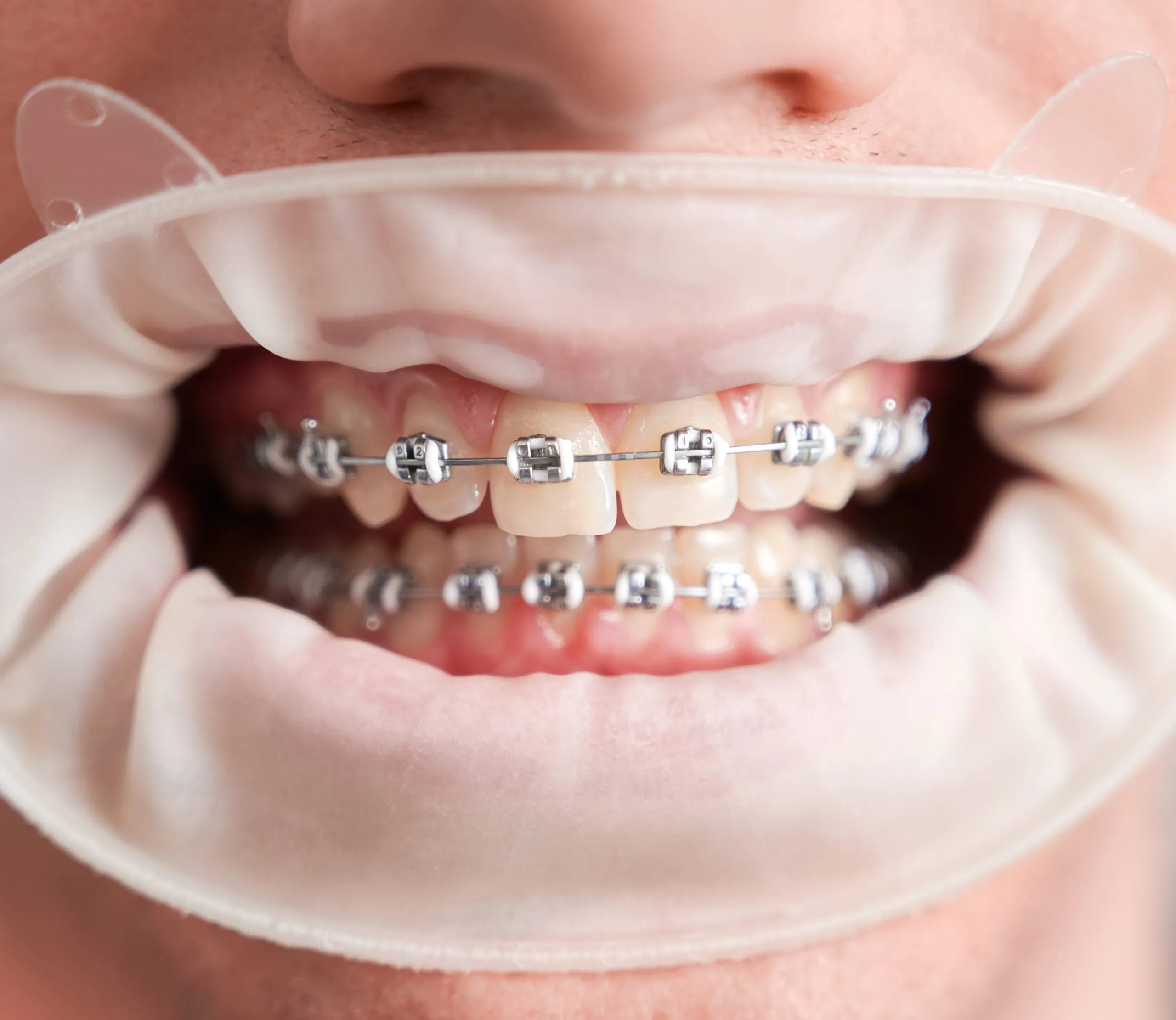 Traditional braces on teeth