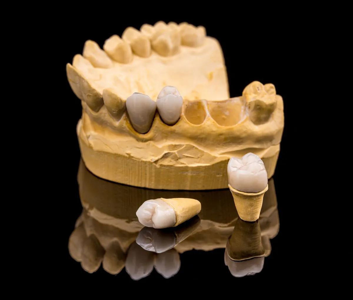Dental crown and bridge model showing tooth replacement options