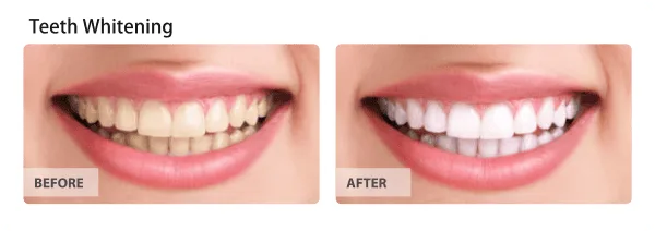 Before and after teeth whitening results
